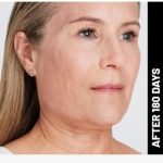 Ultherapy Before & After Patient #1545